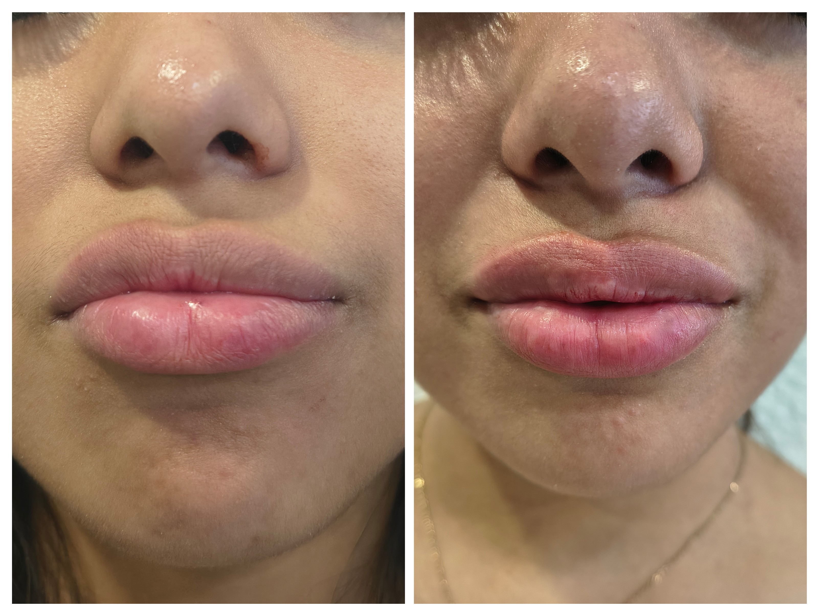 Relleno de Labios