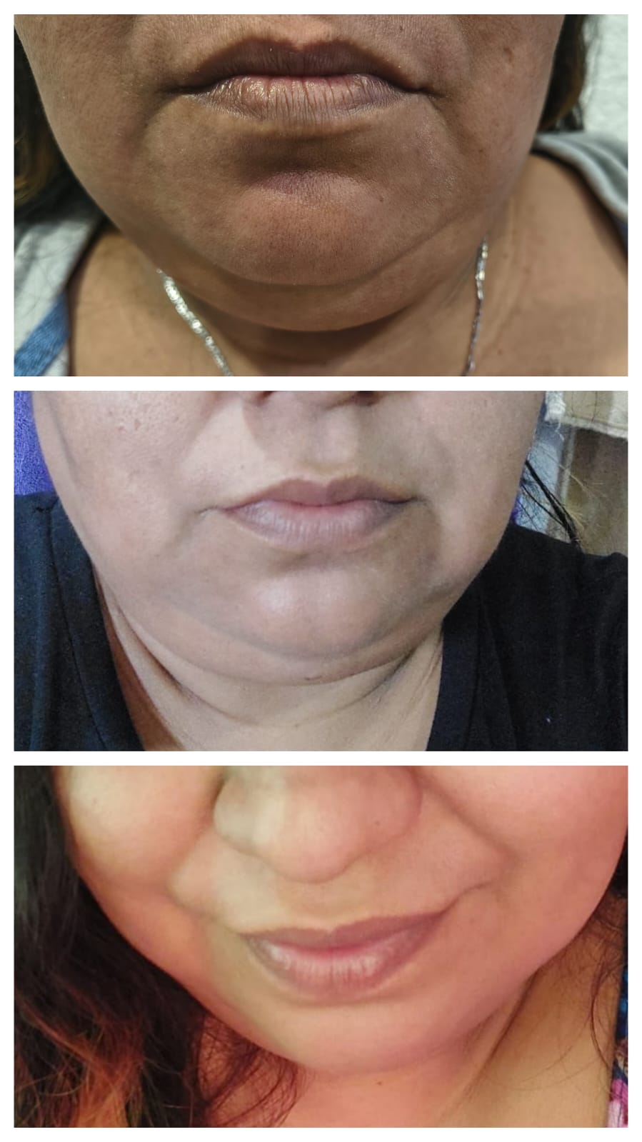 Lipopapada