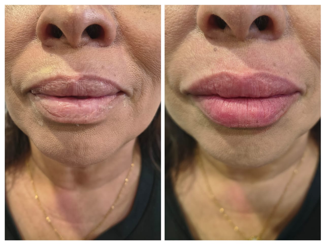 Antes y después relleno labios